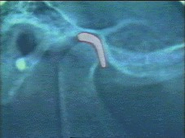 顎関節のレントゲン写真と関節円板(図)