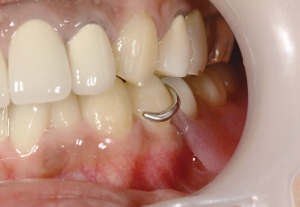 従来型の義歯