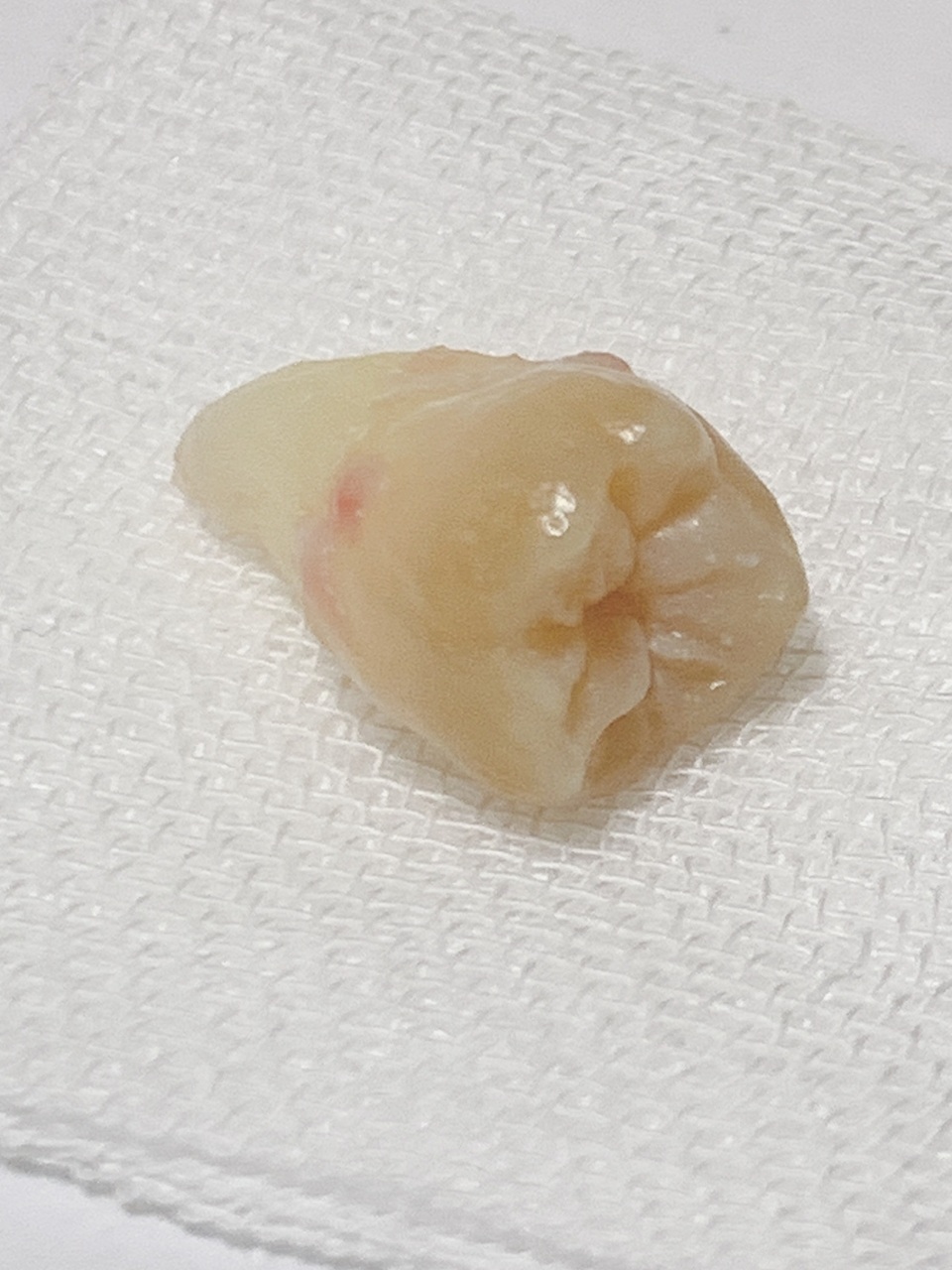 横向き・埋まっている親知らずの抜歯