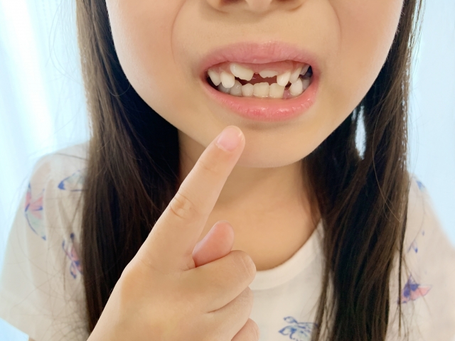 子どもの歯並び相談と矯正を始めるタイミング